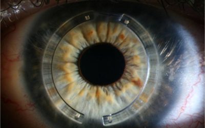 Avances Tecnológicos en Oftalmología pt.2