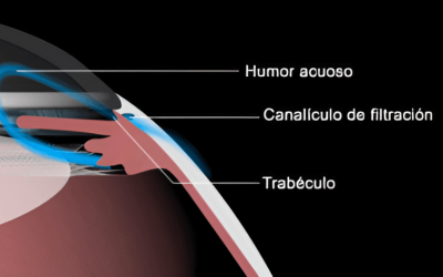 Prevenir y tratar el glaucoma mediante el láser SLT