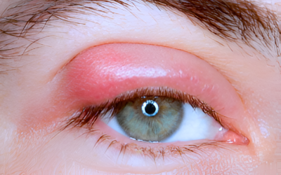 ¿Qué son los orzuelos y cómo tratarlos?