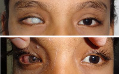 ¿Puedo cambiarme el color de los ojos?