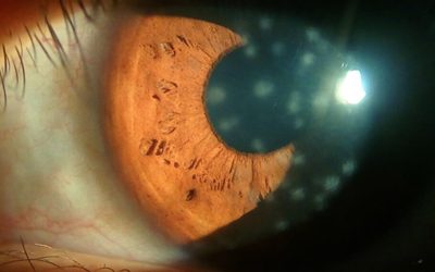 Fotoqueratitis: el lado más oscuro del sol